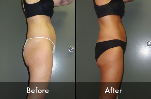 Lipo Light Before and After
